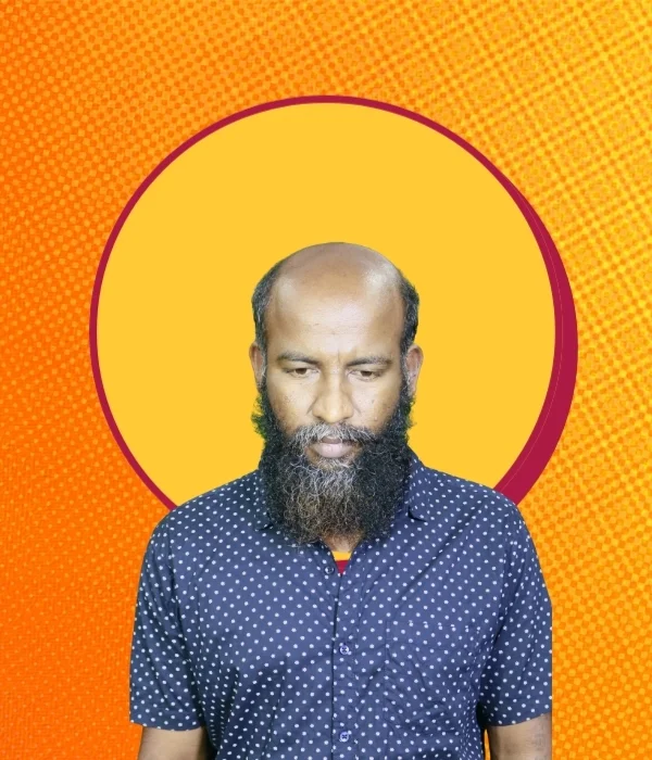 Before hair patch — fully bald, Marathahalli client 3